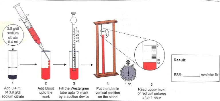 erythrocyte sedimentation rate